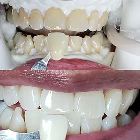 24777 teeth whitening clifton nj 2
