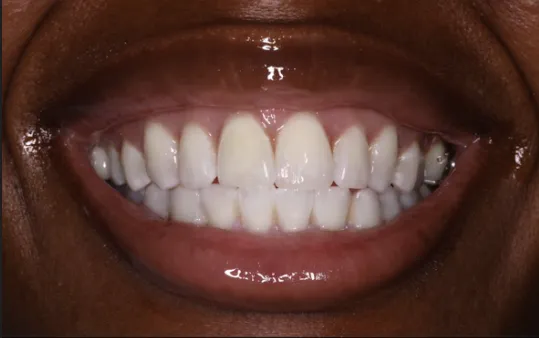 24777 teeth whitening clifton nj 5