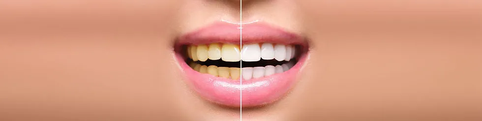24785 in office teeth whitening