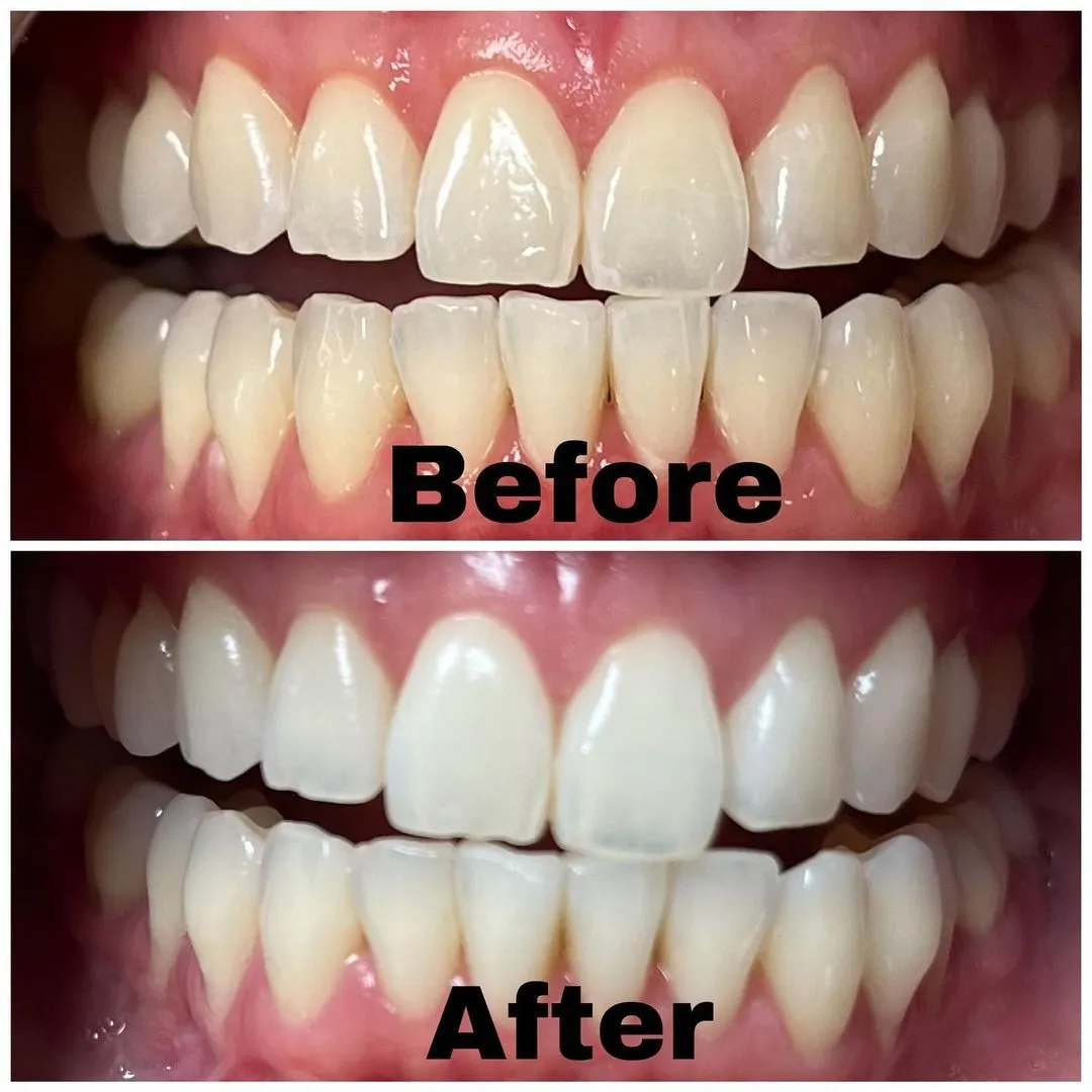 /img/24787-teeth-whitening-food-drinks-santa-clarita.webp
