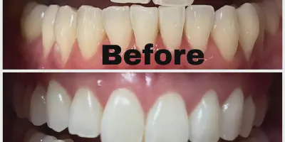 /img/24787-teeth-whitening-food-drinks-santa-clarita.webp
