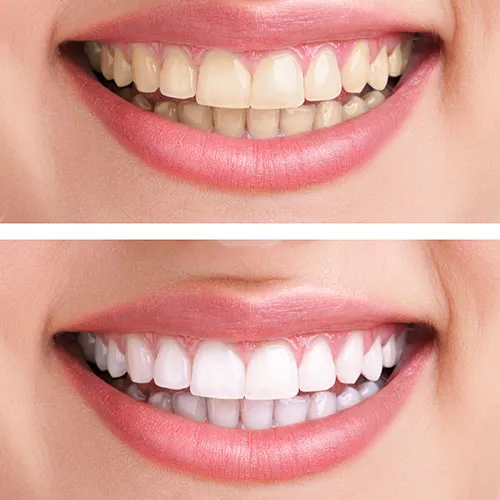 24787 teeth whitening maintenance santa clarita