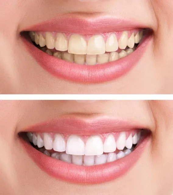 24811 professional teeth whitening image5