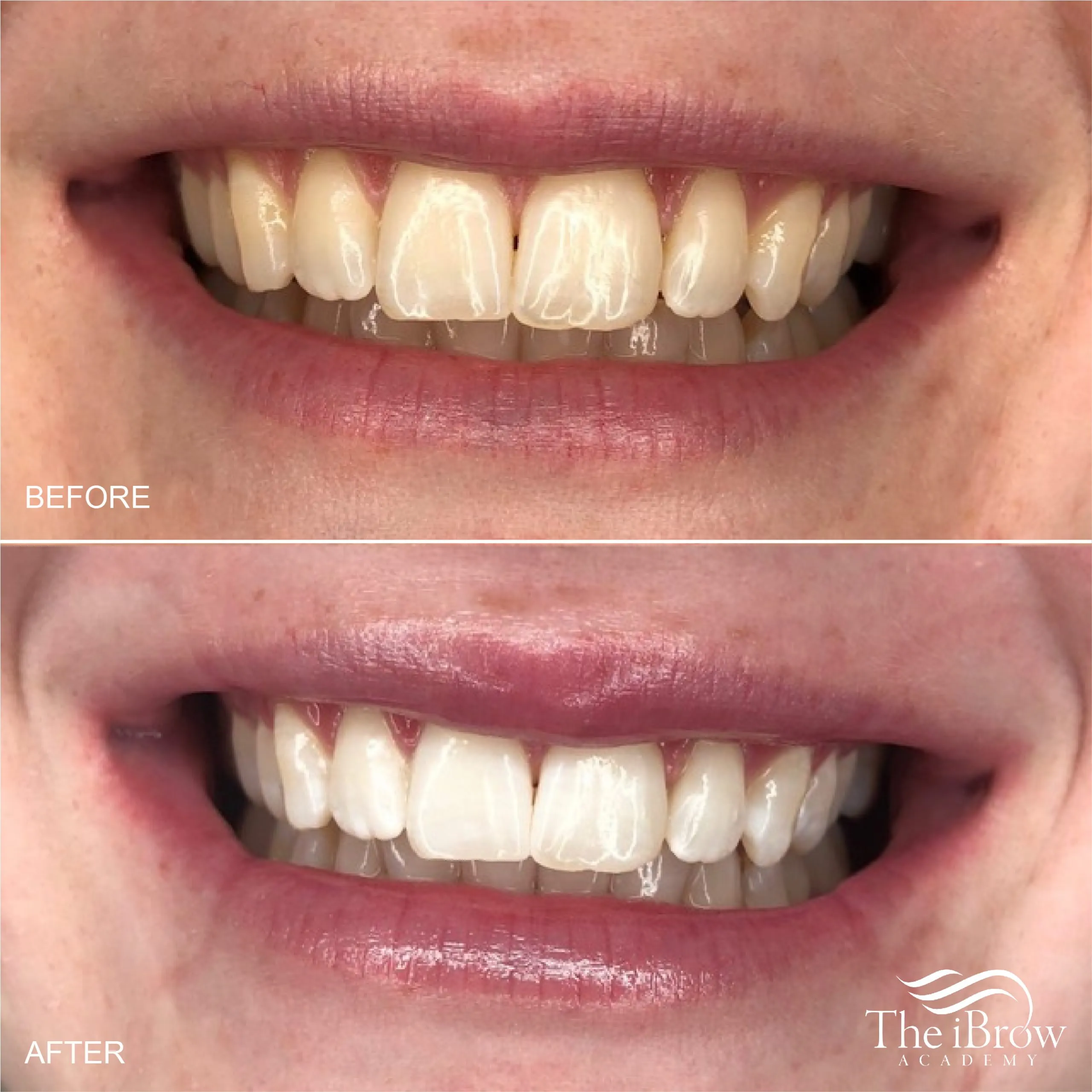 24812 professional teeth whitening