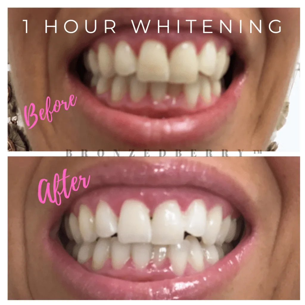 /img/24812-teeth-whitening-smile.webp
