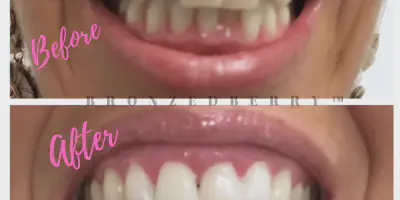 /img/24812-teeth-whitening-smile.webp