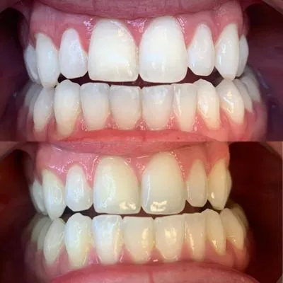 24816 choosing teeth whitening