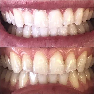 24816 teeth whitening cost