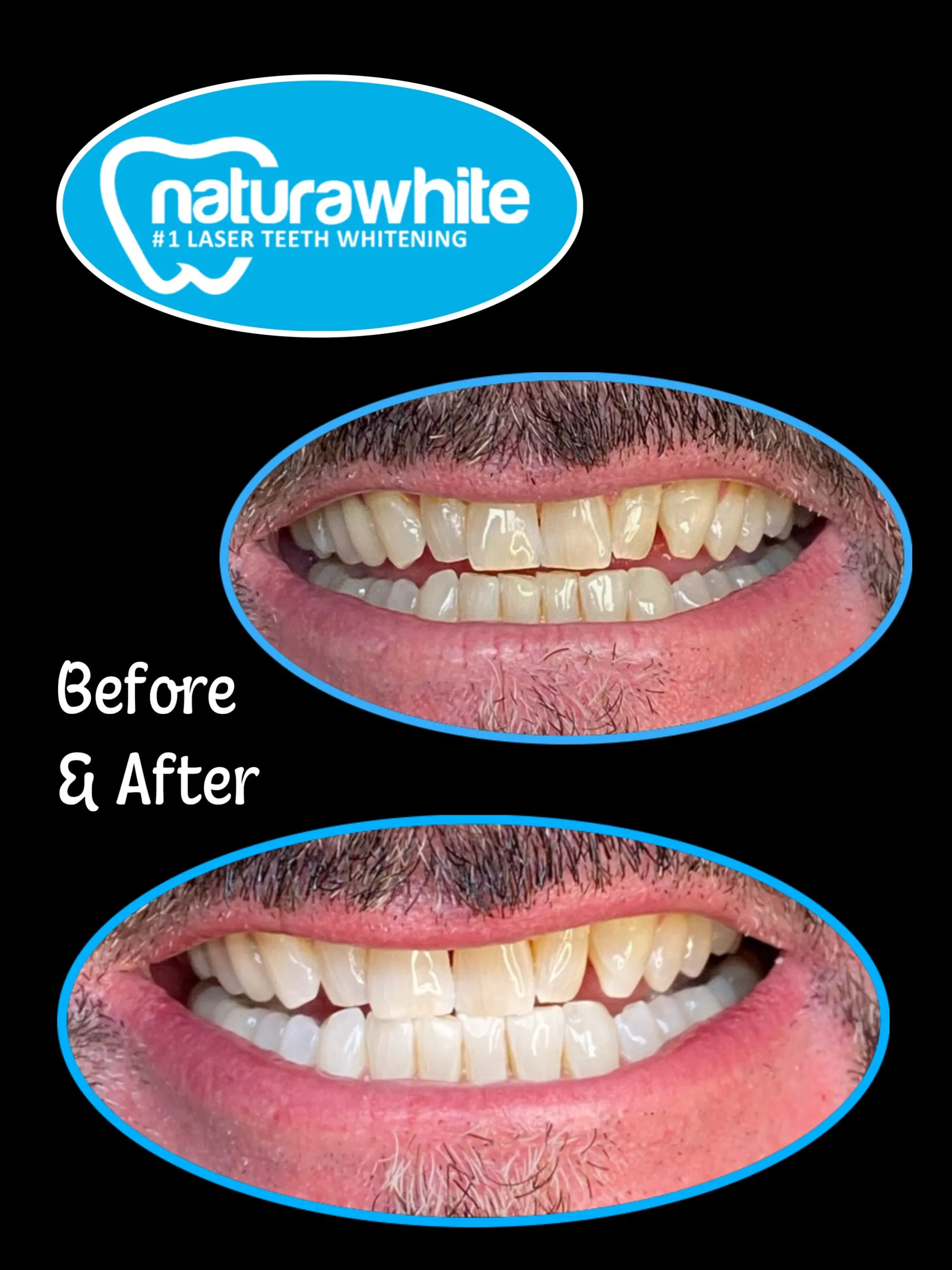 24818 teeth whitening before after