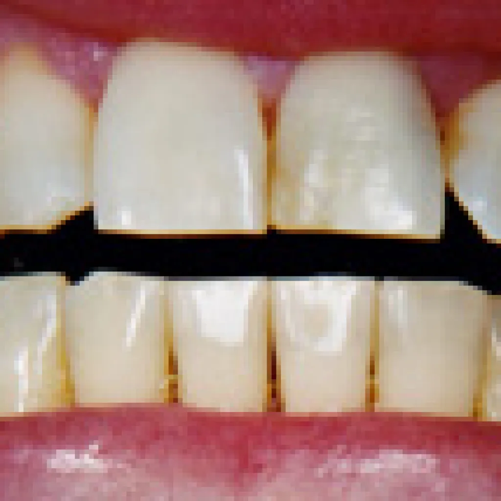24827 sensitive teeth