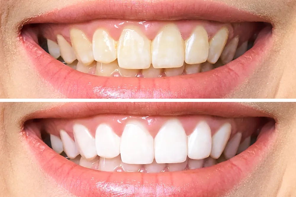 24828 dayton teeth whitening at home