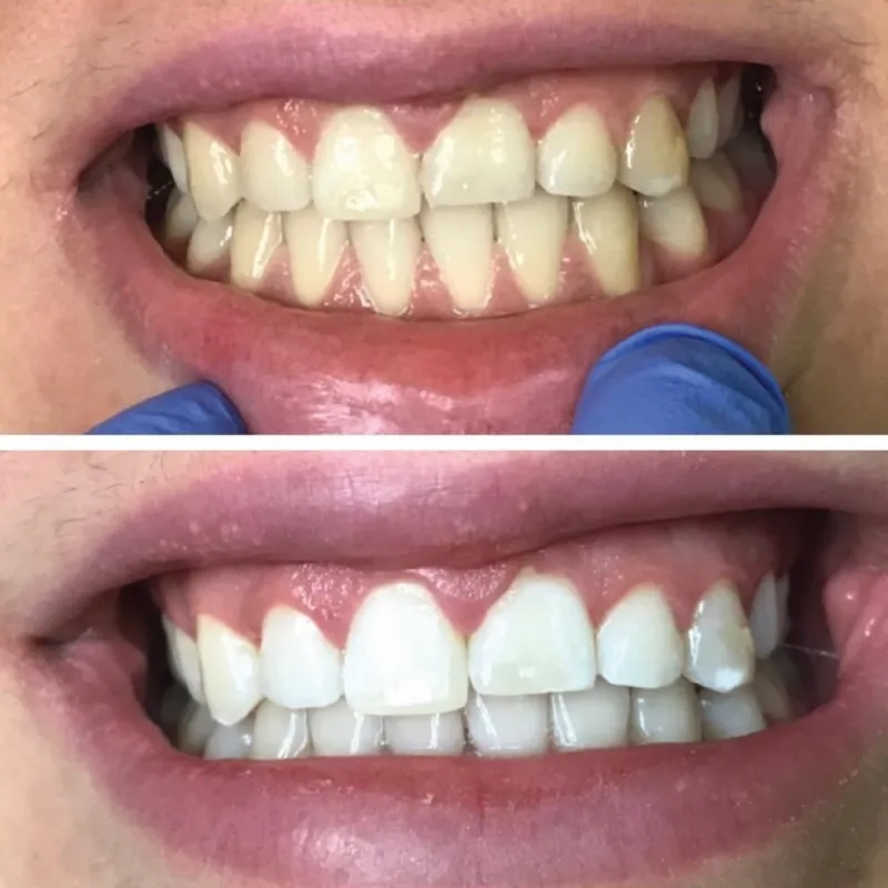 24828 dayton teeth whitening custom trays