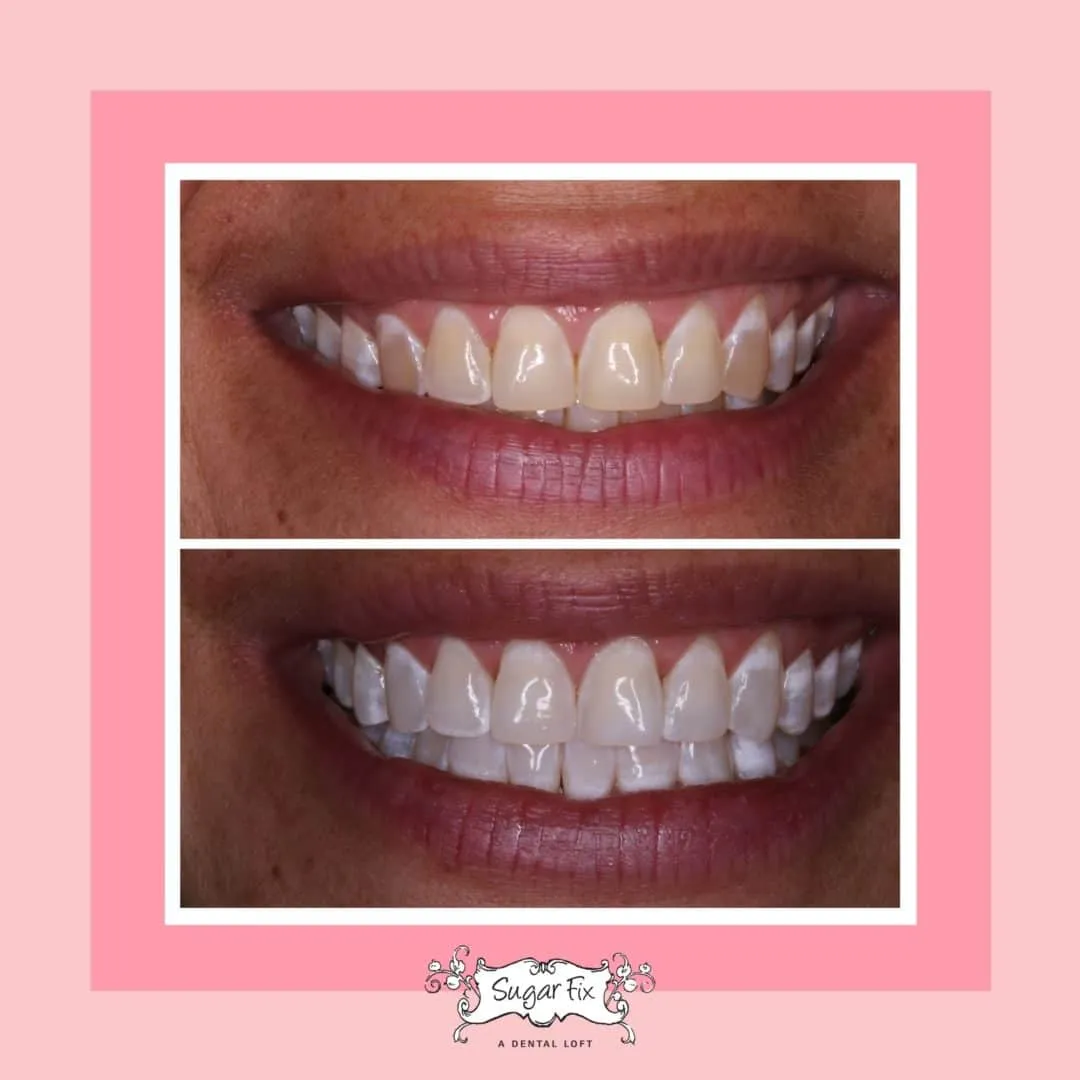 24828 dayton teeth whitening in office