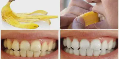 /img/24830-banana-peel-teeth-whitening-7.webp