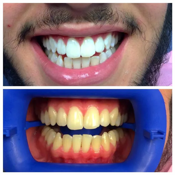 24843 professional teeth whitening