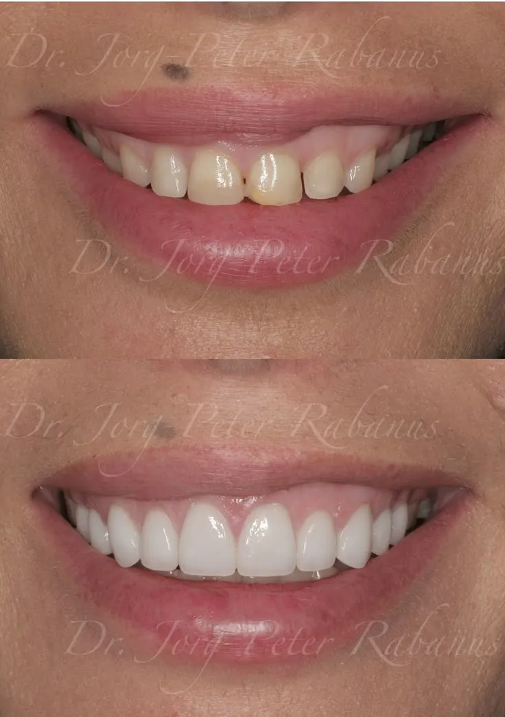 24846 over the counter whitening