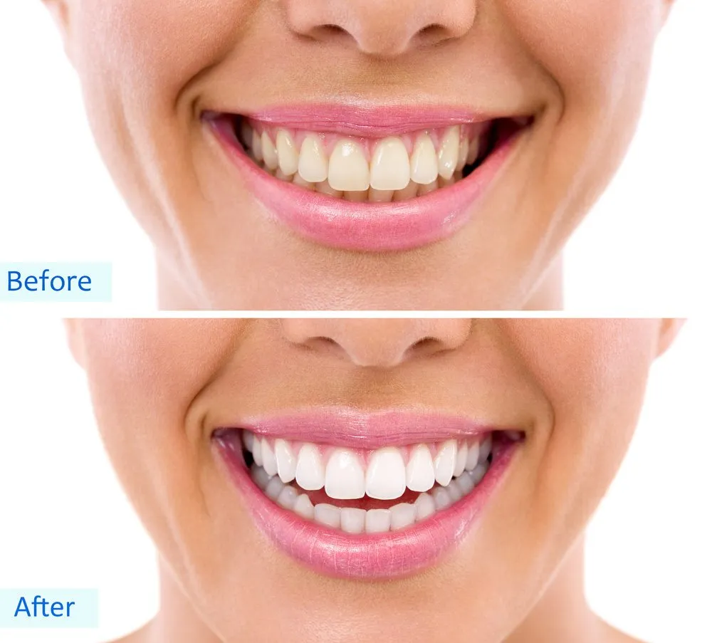 /img/24846-reduce-teeth-whitening-costs.webp