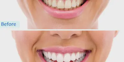 /img/24846-reduce-teeth-whitening-costs.webp