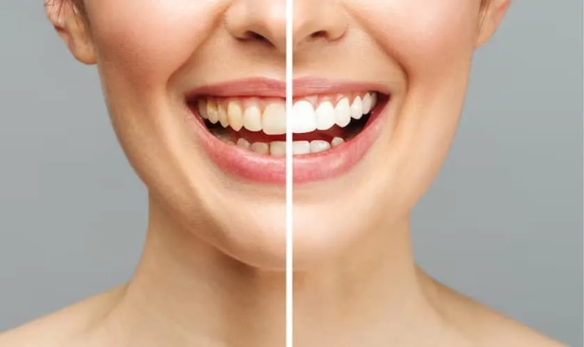 24849 maintaining teeth whitening