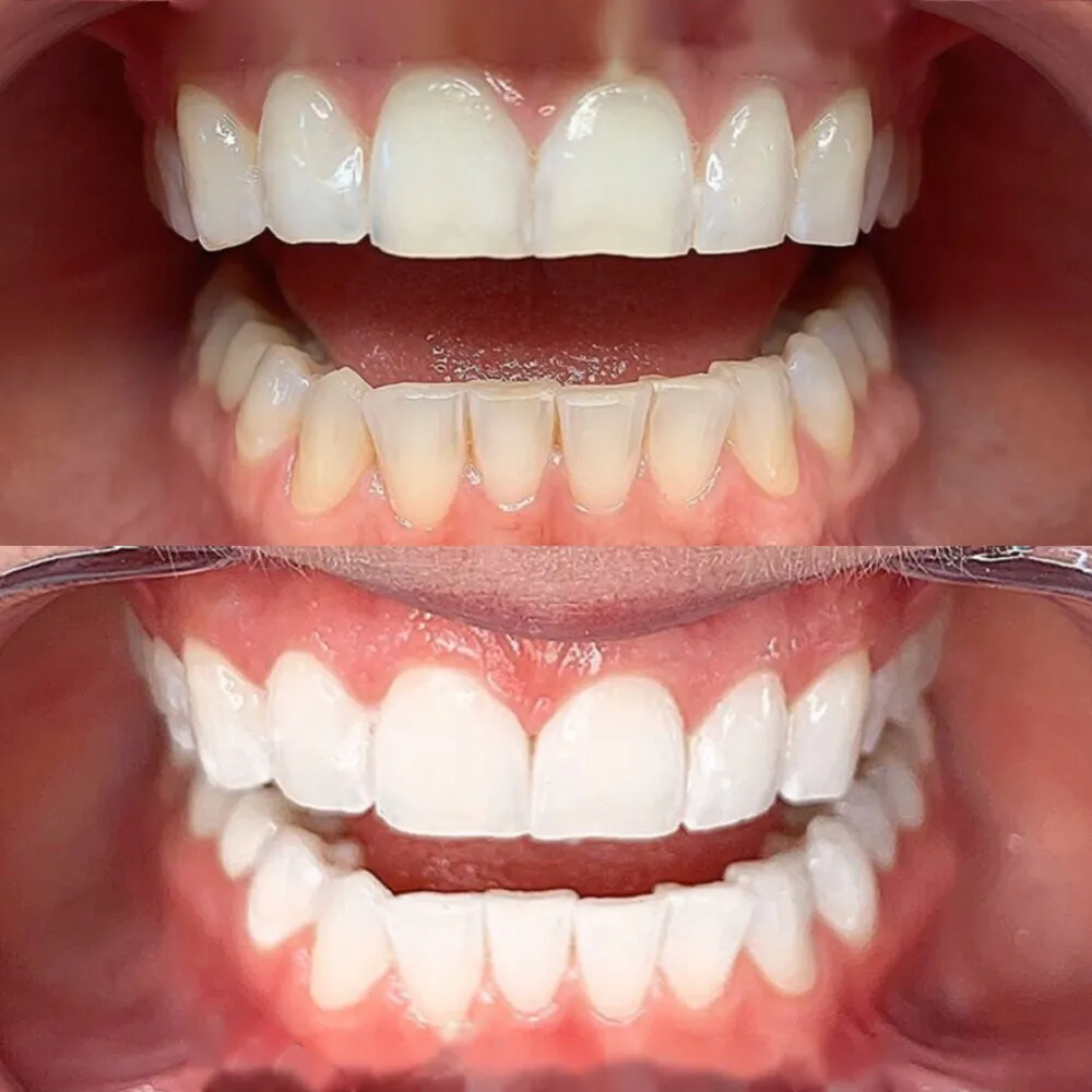 /img/24851-dental-bonding.webp