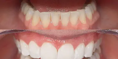 /img/24851-dental-bonding.webp