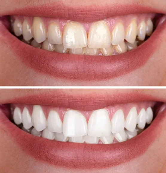 24854 tucson teeth whitening dentist consultation