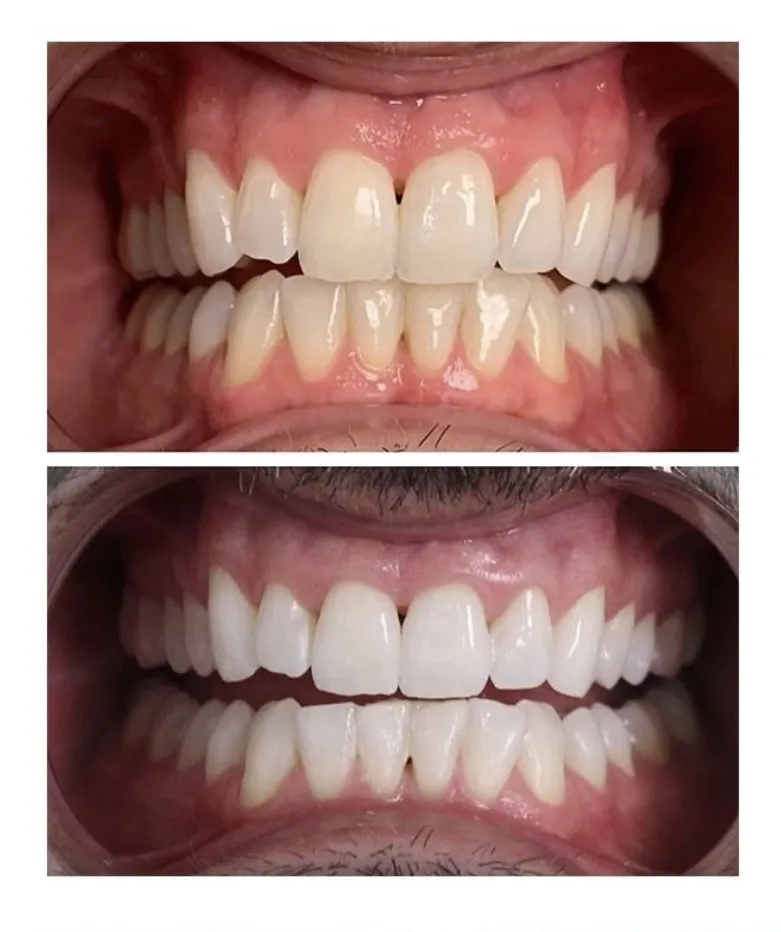 24854 tucson teeth whitening professional treatment