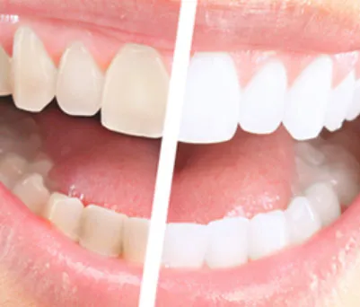 24855 professional teeth whitening treatment