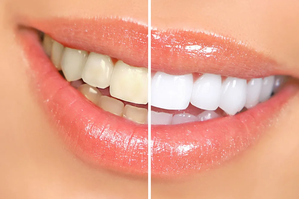 24855 teeth whitening dental health