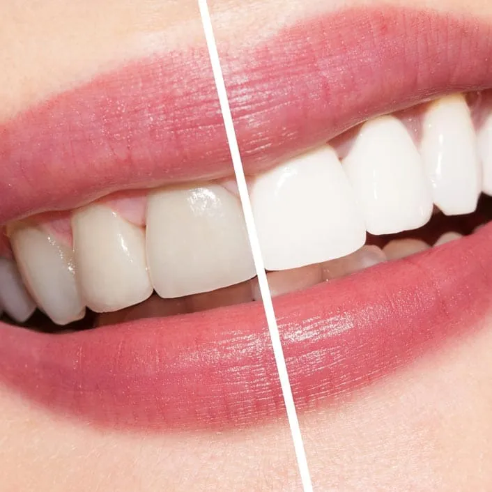 24855 teeth whitening safe methods