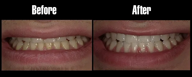 /img/24857-lasting-white-smile.webp