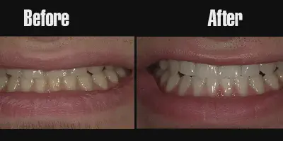 /img/24857-lasting-white-smile.webp