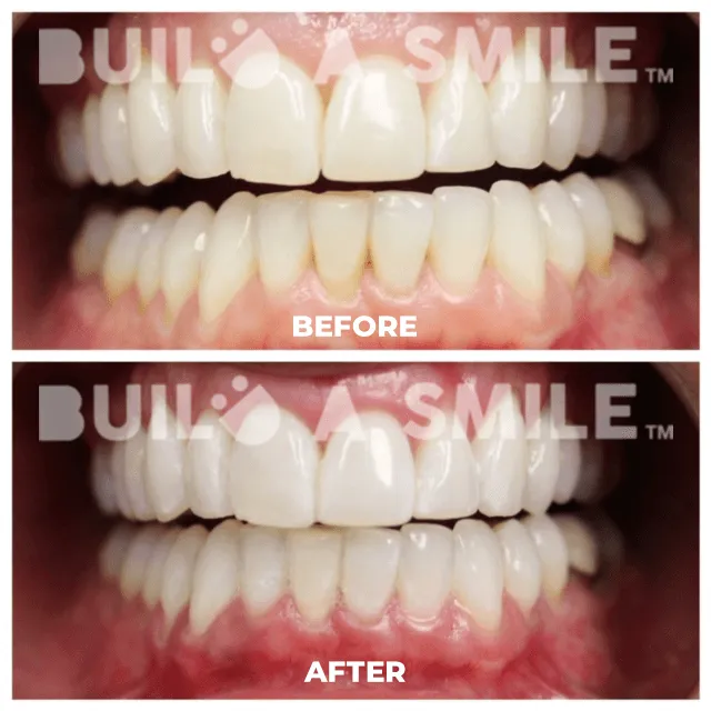 24857 professional teeth whitening