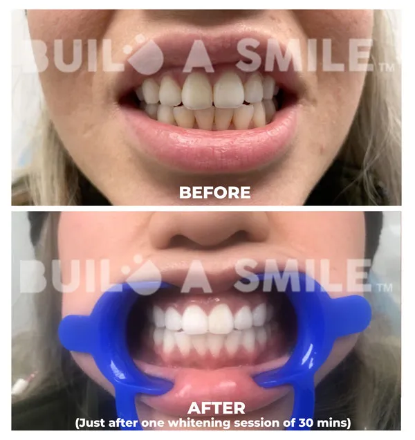 24857 teeth whitening at home