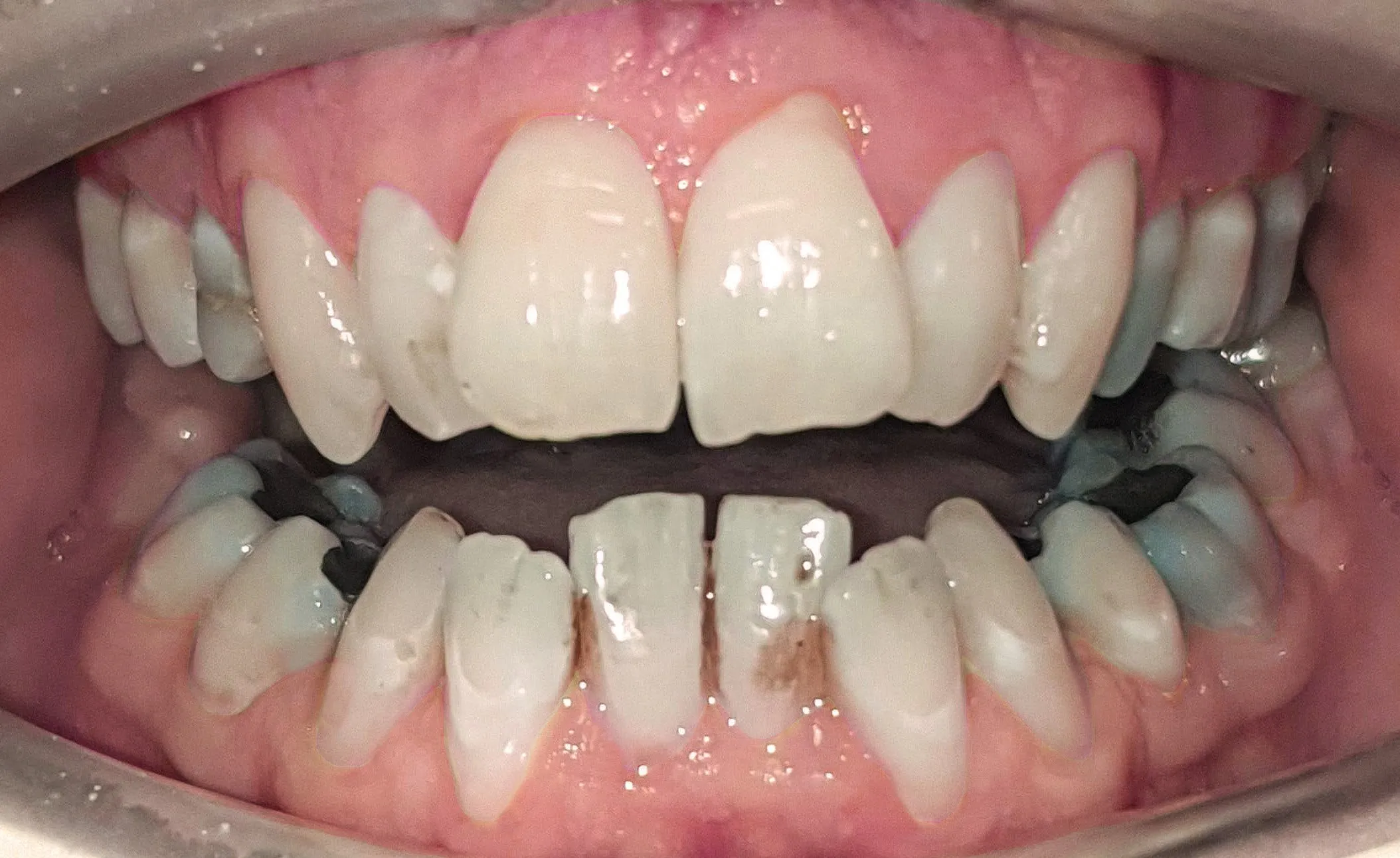 24858 custom whitening trays