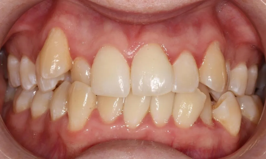 24858 whitening strips