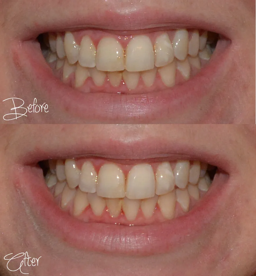 24863 baking soda teeth whitening 4