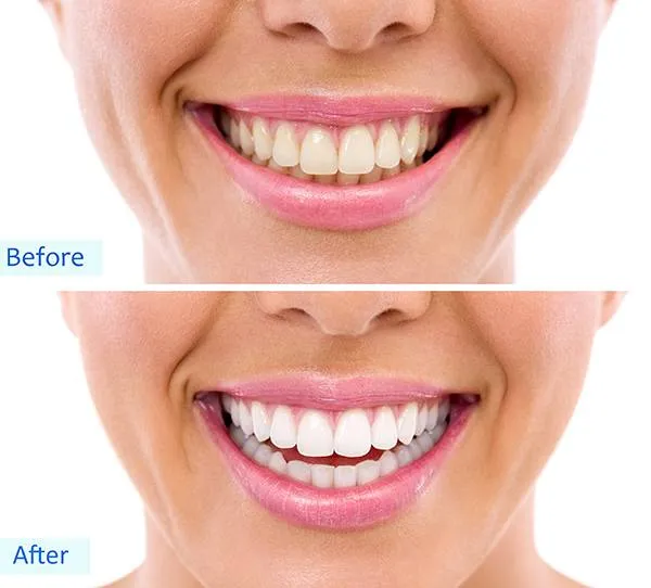 24866 teeth whitening procedure
