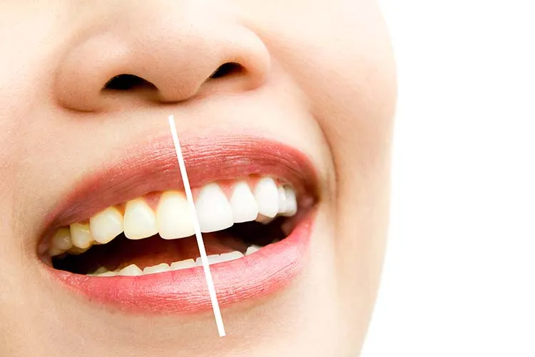 24867 at home teeth whitening kits