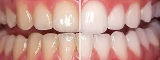 24867 teeth whitening aftercare issaquah