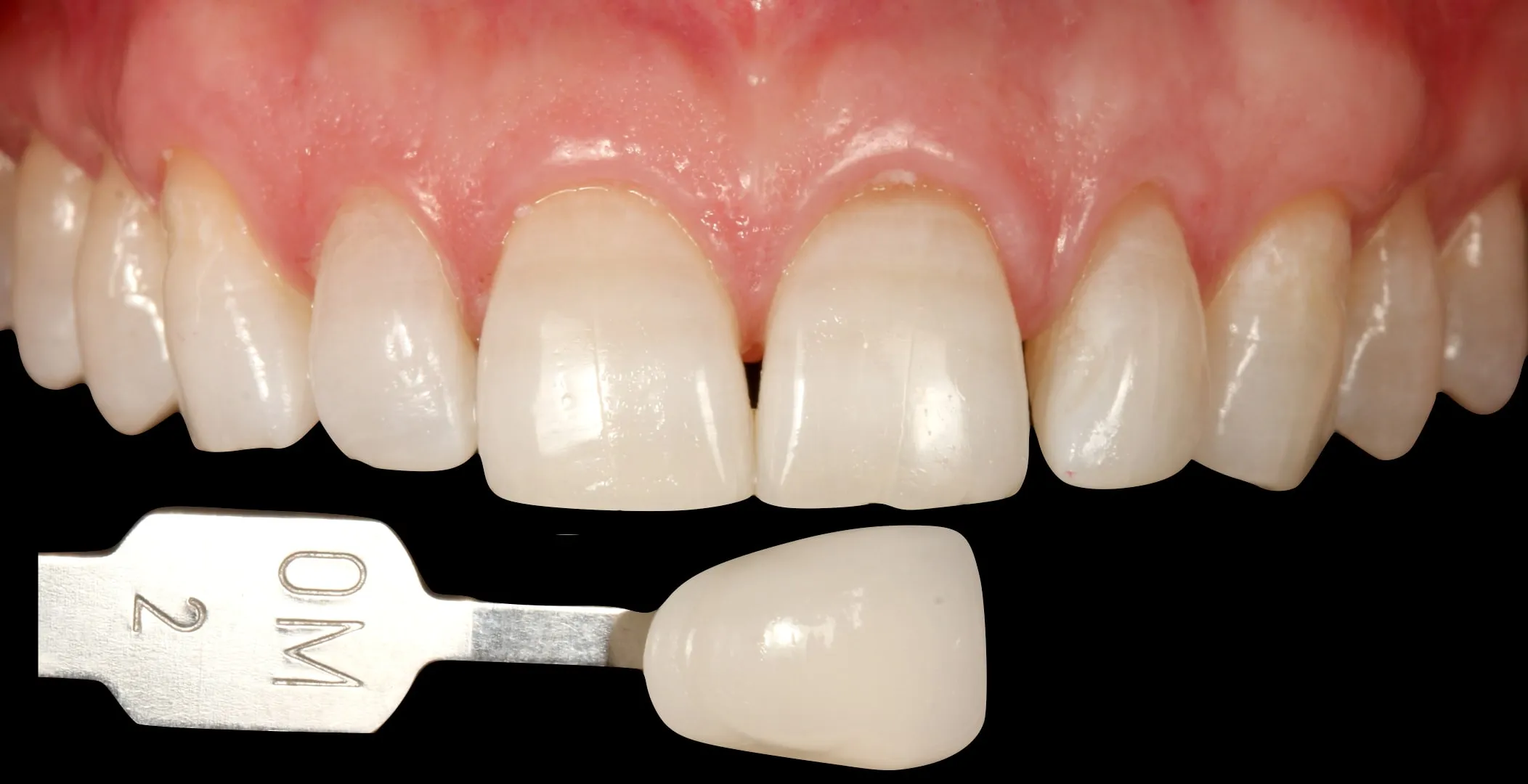 24879 at home teeth whitening