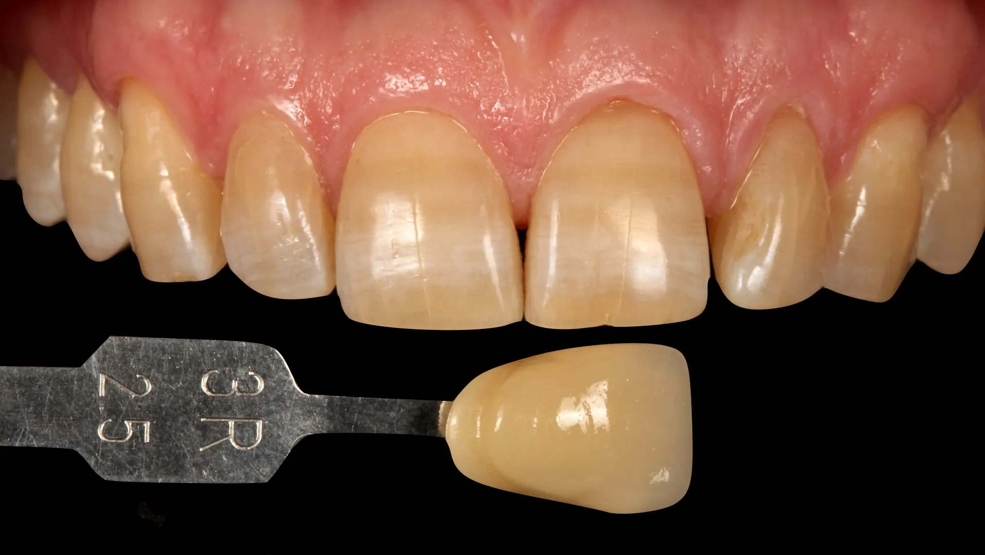24879 dental veneers
