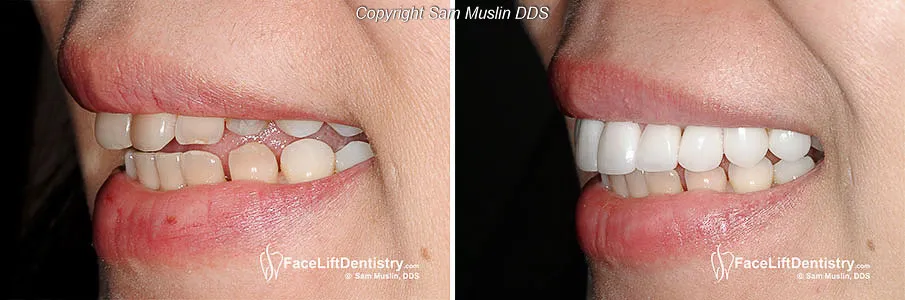 24879 professional teeth whitening