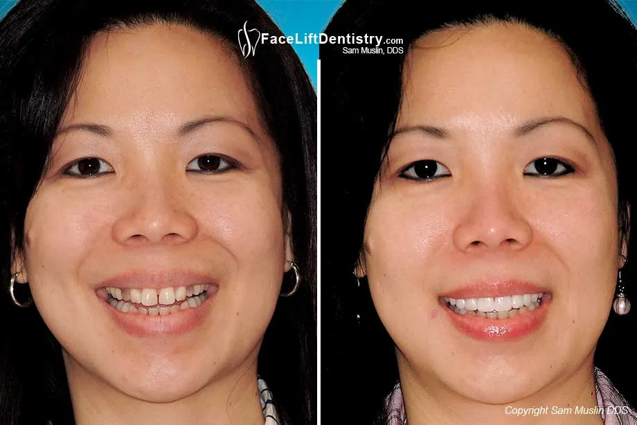 24879 tetracycline stain causes