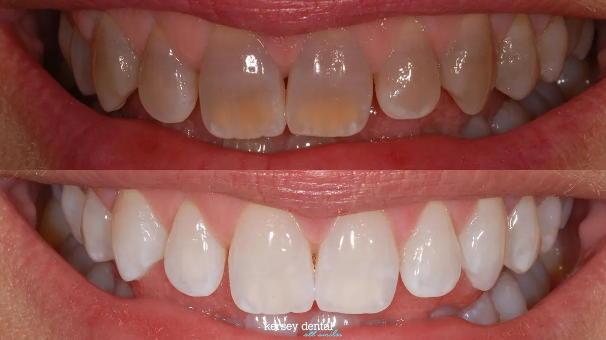 24879 tetracycline stained teeth