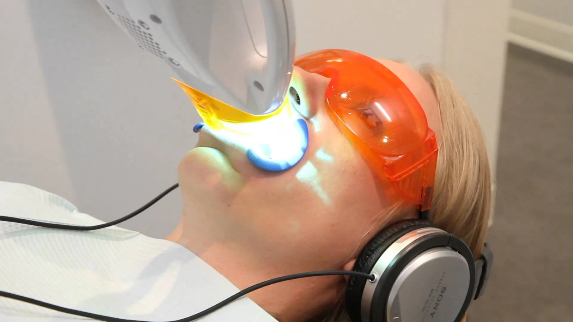 24880 dental veneers