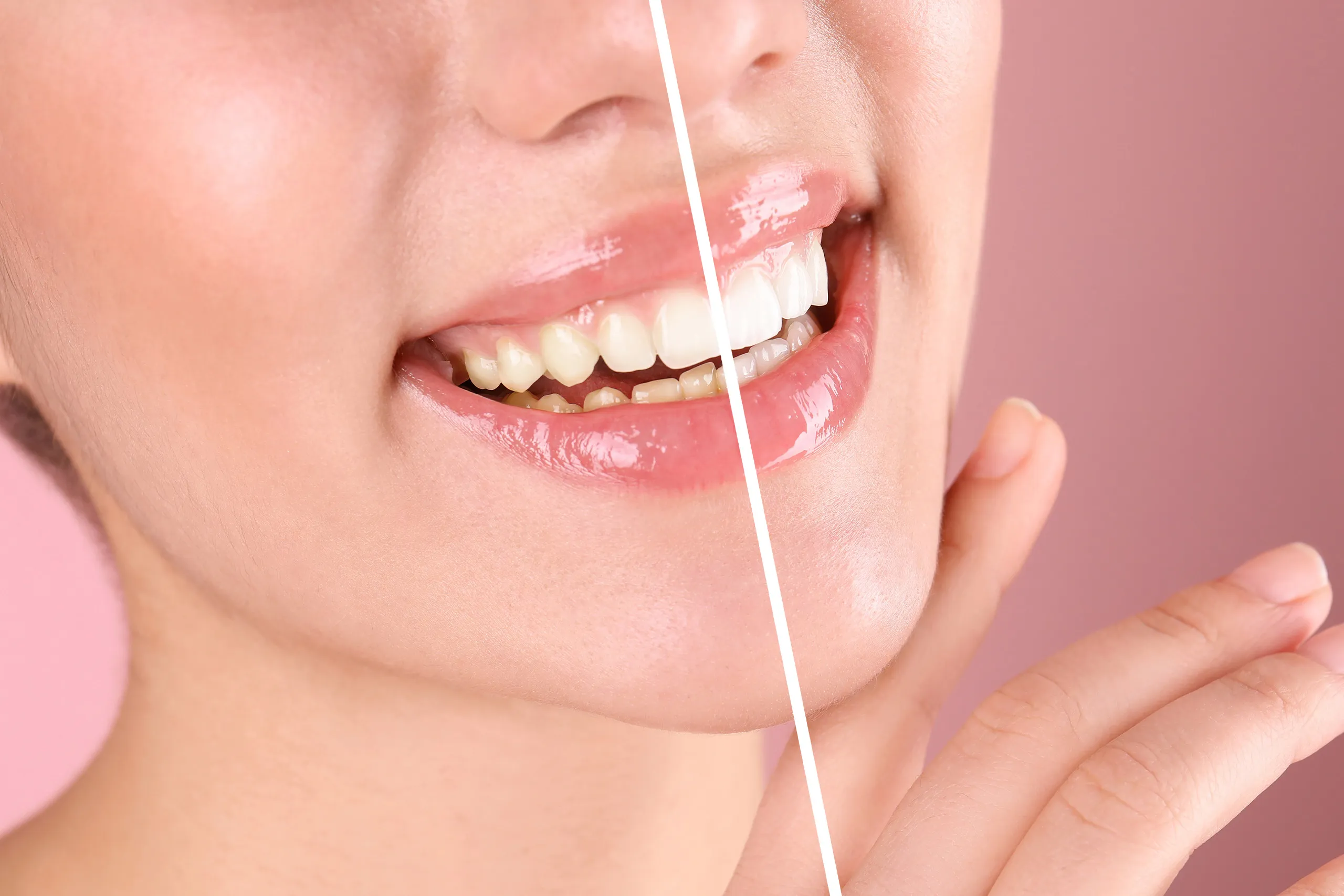 24883 tooth discoloration causes