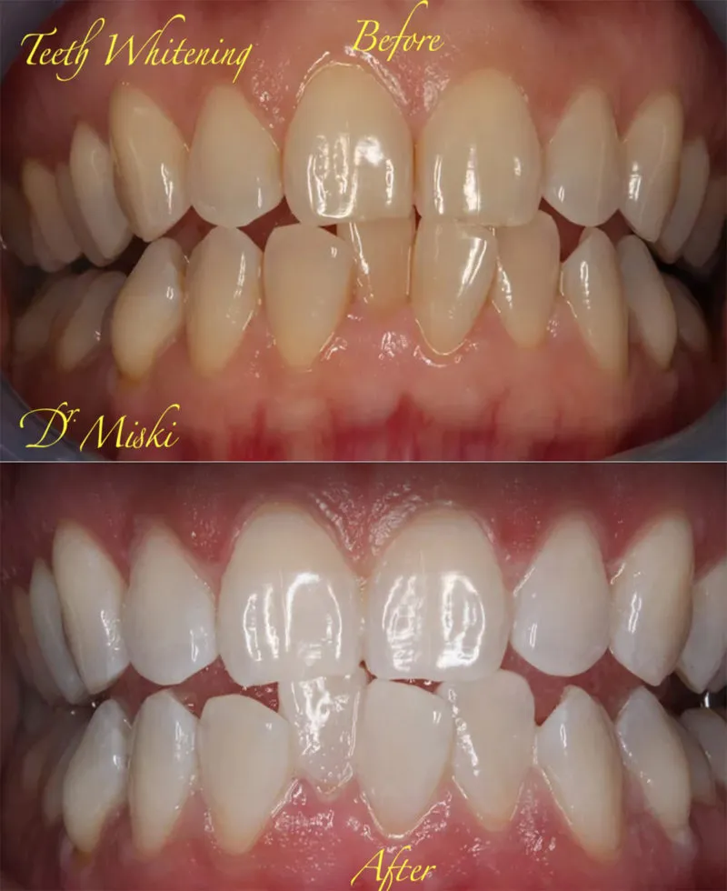 24891 teeth whitening diet