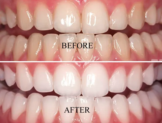 24894 teeth whitening professional