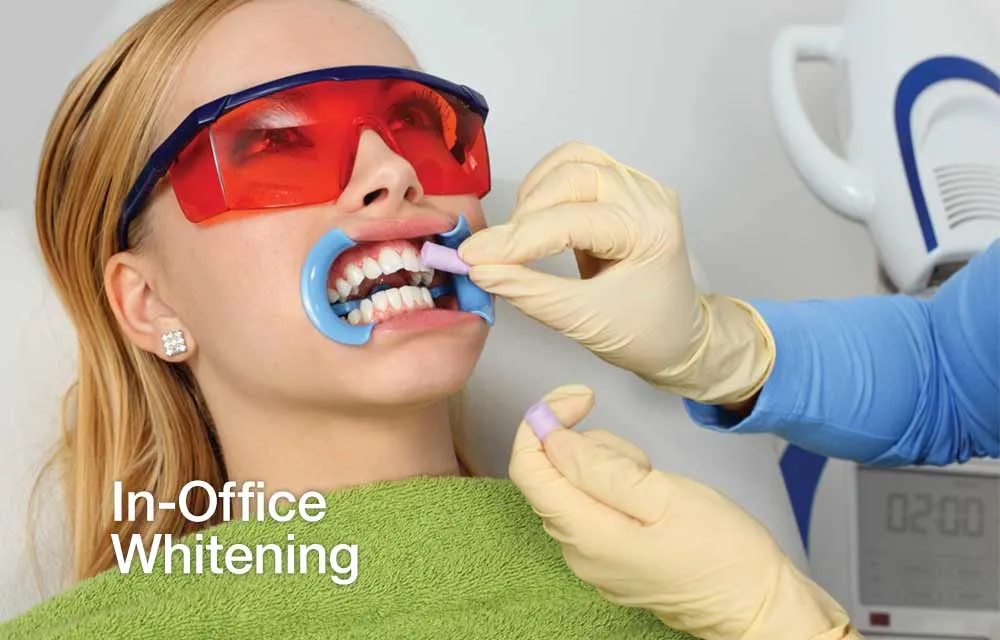 /img/24898-seattle-teeth-whitening-diet.webp